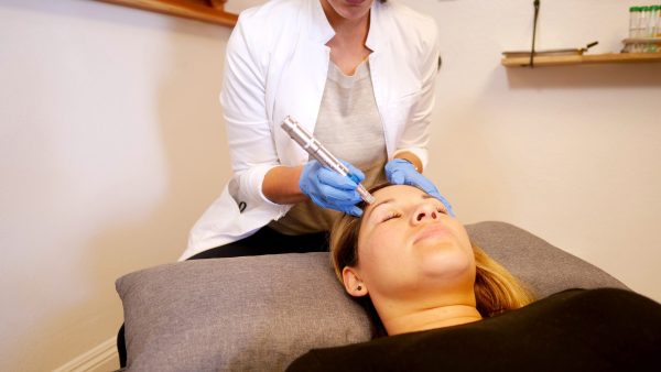 woman receiving microneedling for younger skin