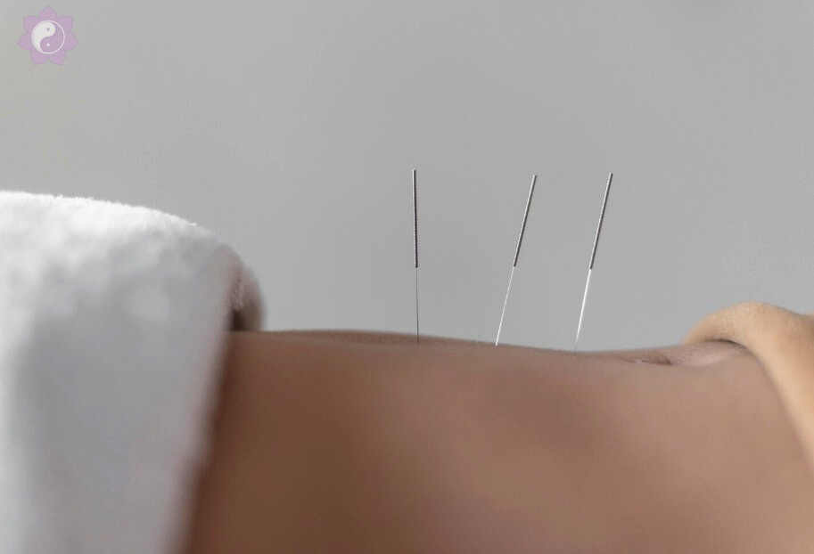 What does acupuncture feel like? Does acupuncture hurt? Acupuncture needles in a patient
